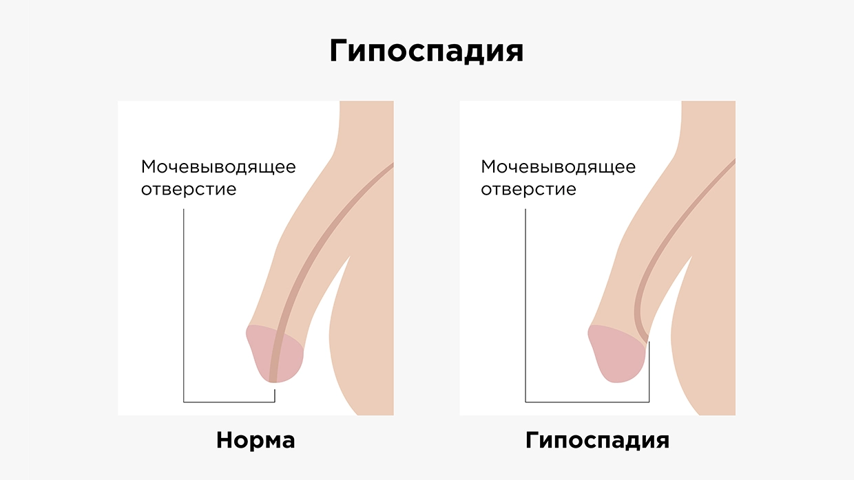 Половое развитие мальчиков